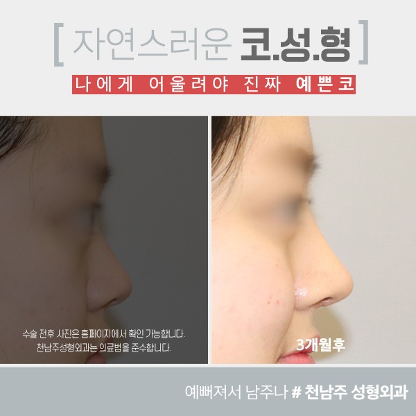 기증진피 코성형 후기 - 시보드