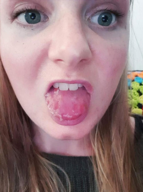 20대 호주 여성의 혀 부풀고 까맣게 변한 원인이 무엇일까?, 시보드 블로그