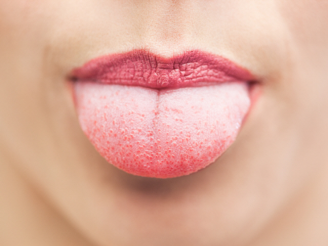 혀가 아프지만 입 속에 이상이 없을 때 원인과 대처법, 시보드 블로그