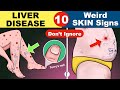 10 Skin signs of Liver Disease | Fatty liver | Cirrhosis of the Liver | Fatty liver Symptoms