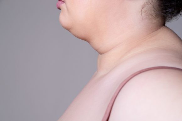 달덩이 같은 얼굴과 중심성 비만…‘쿠싱증후군’ 의심해야